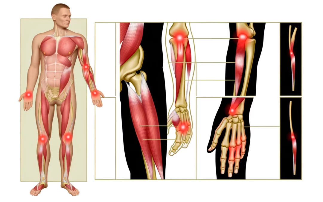 Revolutionizing Tendinitis Management: A New Dawn with Rife Therapy and Electroherbalism